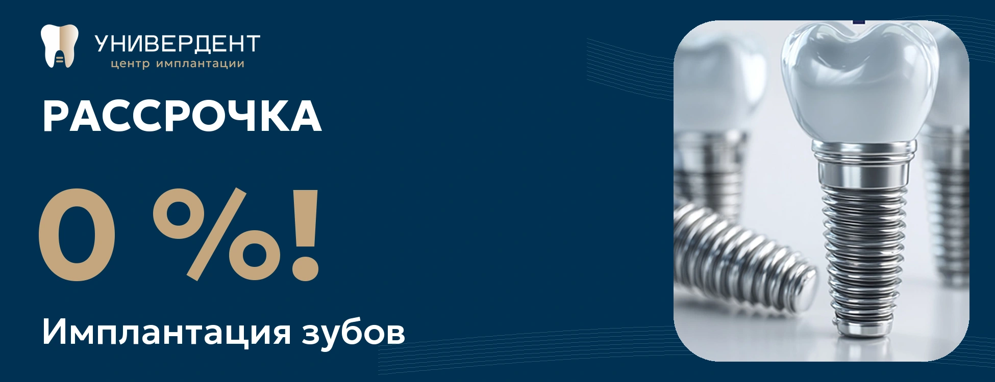 Имплантация зубов