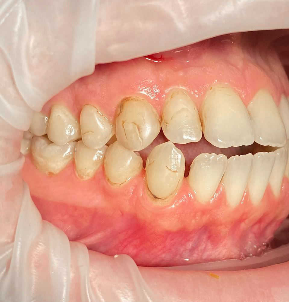 реставрация зубов 1