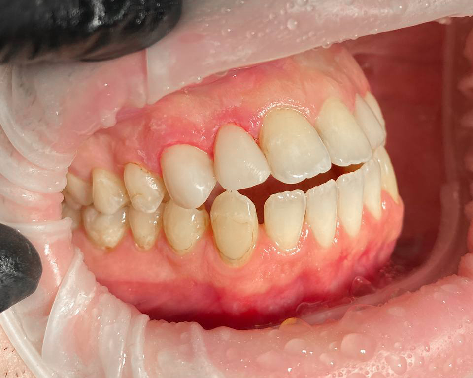 Реставрация зубов 2