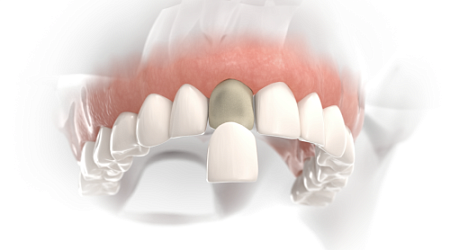 Композитные виниры и реставрация зубов