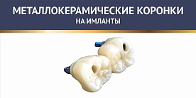 Металлокерамические коронки