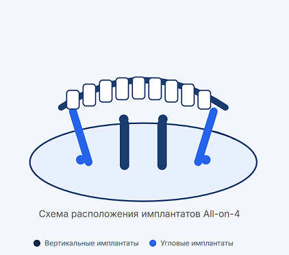 Схема расположения имплантатов Все на 4